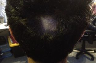 No, this is not precocious baldness... But the place from which a hair sample was taken. 